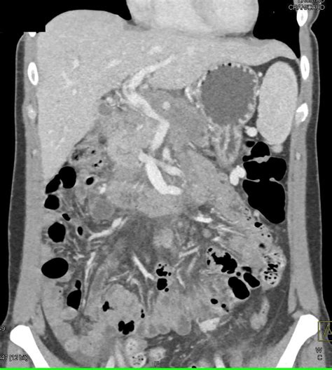 Pancreatic Adenocarcinoma With Extensive Adenopathy Liver Metastases