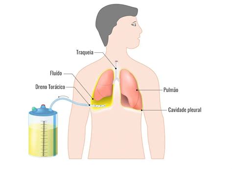 Dreno Torácico - Cirurgia Torácica do Vale