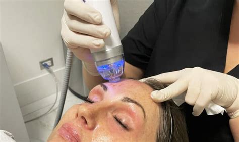 Radiofrequenza Frazionata Micro Needling RF BeautyMedlux Italia