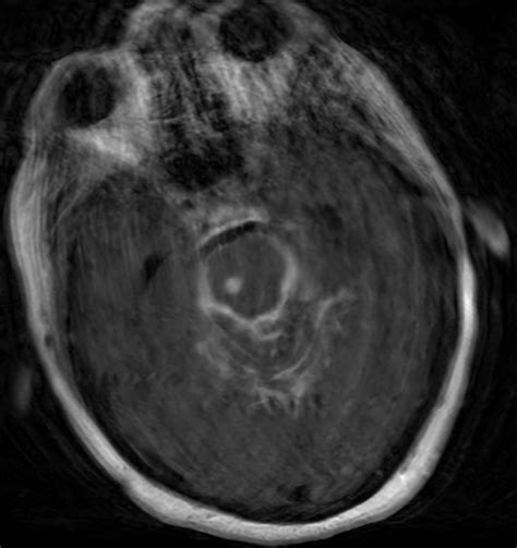 Figure Tuberculous Meningitis On Computed Tomography Contributed By