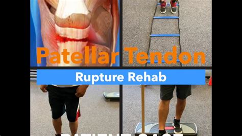 Patellar Tendon Repair Rehab YouTube