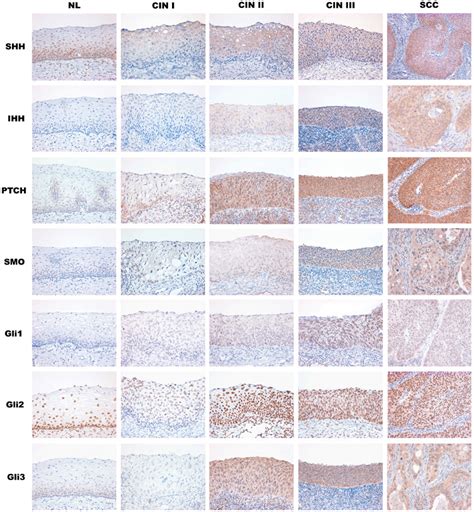 Enhanced Expression Of Hedgehog Signaling Molecules In Squamous Cell