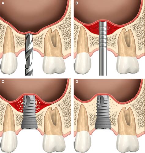 Sinus Augmentation In Brooklyn NY Crown Heights Fort Greene Park