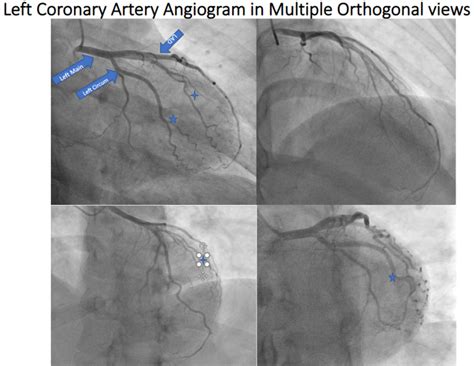 Figure Left Coronary Angiogram Various Orthogonal Statpearls