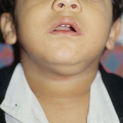 Pediatric Neck Masses John E Mcclay Md