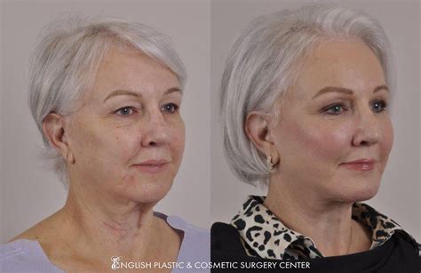 Dermabrasion Before & After | English Plastic & Cosmetic Surgery