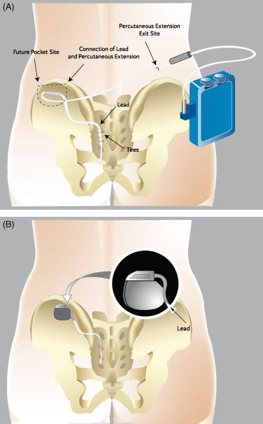 Latest Technologic And Surgical Developments In Using Interstim™ Therapy For Sacral