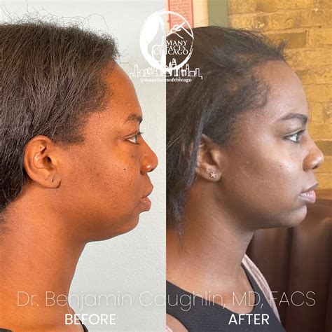 Combination Of Buccal Fat Removal Jawline Sculpting Chin Implant