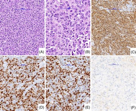 A Low Power He X Large Atypical Lymphoid Cells Arranged In Diffuse