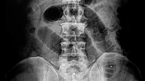 Obstrucción intestinal síntomas causas tratamiento