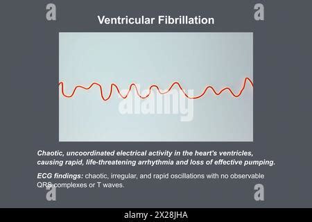 ECG in ventricular fibrillation, illustration Stock Photo - Alamy