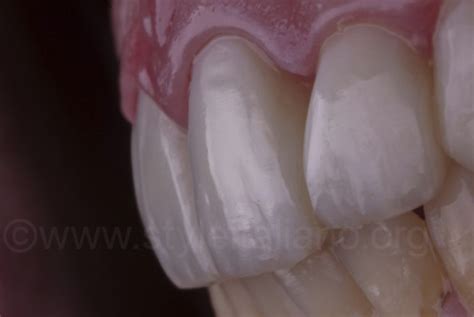 Smile Makeover With Direct Composite Veneers