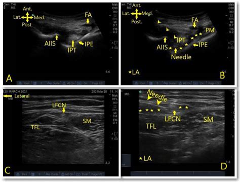 Does Adding Lateral Femoral Cutaneous Nerve Block Improves The