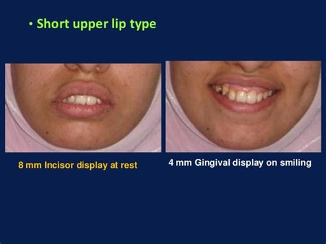 Diagnosis And Treatment Of Gummy Smile