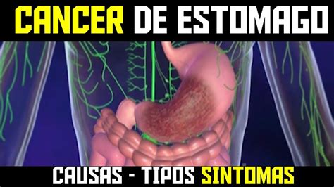 Cancer De Estomago Tipos