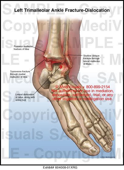 Left Trimalleolar Ankle Fracture Dislocation Medical Exhibit