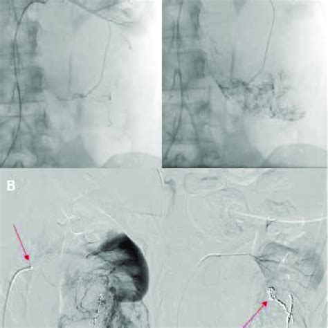 Selective Digital Subtraction Angiography In Patient With Renal Cell