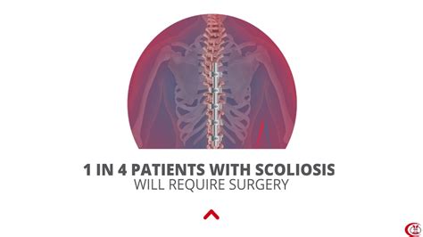 Scoliosis Animated Explainer Video Al Zahra Sharjah No Subtitles Youtube