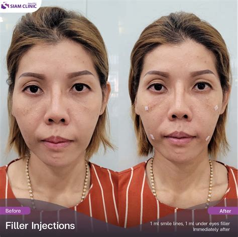 รีวิว ฉีดฟิลเลอร์ Filler Reviews Siam Clinic Thailand