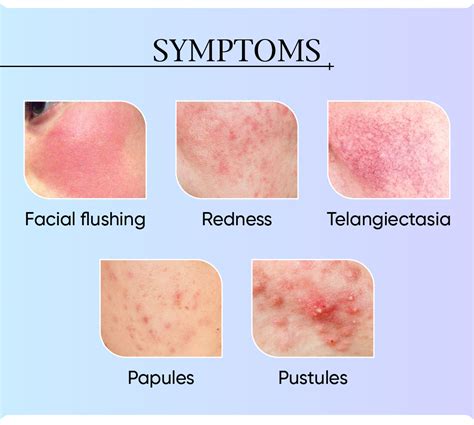 rosacea | Clinic RX