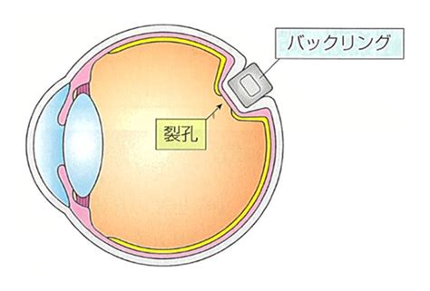 網膜剥離手術 下田眼科