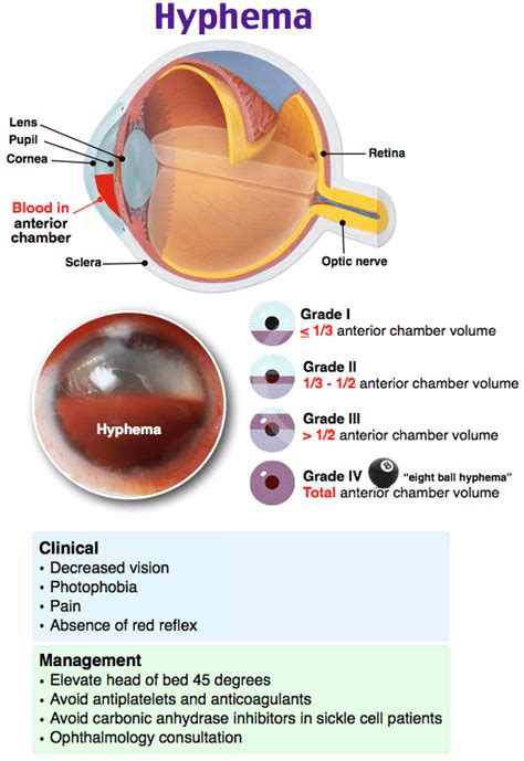 Rapid Review: Hyphema - RoshReview.com