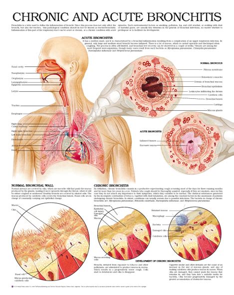 Chronic-and-acute-bronchitis – Anejo