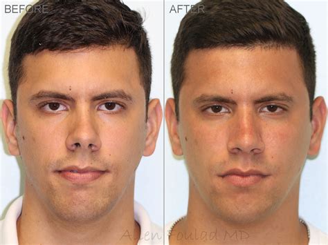 Rhinoplasty In Beverly Hills Allen Foulad Md