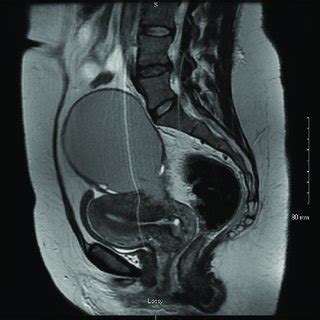 Transvaginal ultrasound scan illustrating left adnexal mass. | Download Scientific Diagram