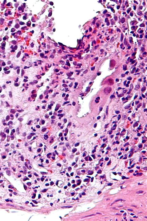 Cytomegalovirus Colitis Libre Pathology