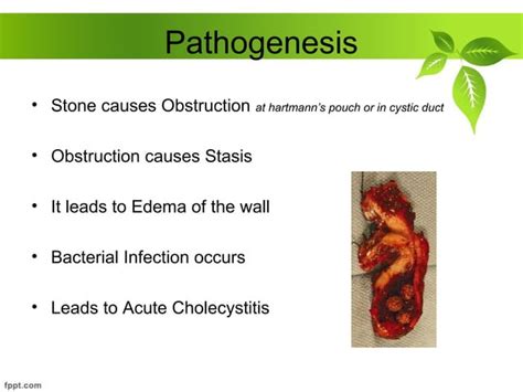 Acute And Chronic Cholecystitis