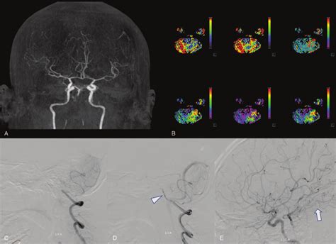 Brain Ct Angiography Showing Complete Occlusion Of The Proximal Portion