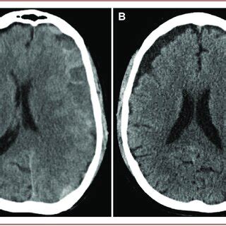 A Axial CT Of A 65 Year Old Patient Who Presented With Progressive