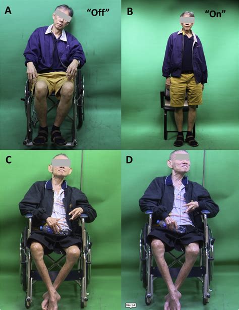 Parkinsonism Related Disorders