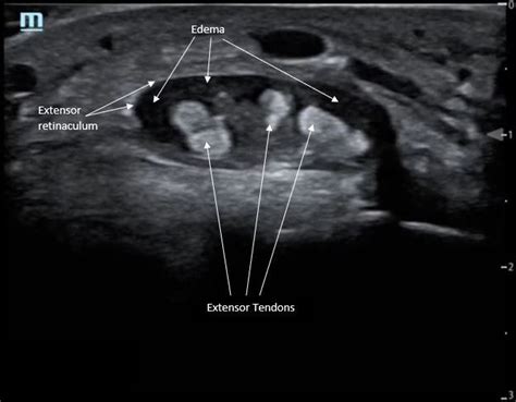 Extensor Tenosynovitis of the Wrist, Axial Image, Annotated. JETem 2019 ...