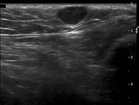 Sonography Of Various Cystic Masses Of The Female Groin Oh 2007 Journal Of Ultrasound In