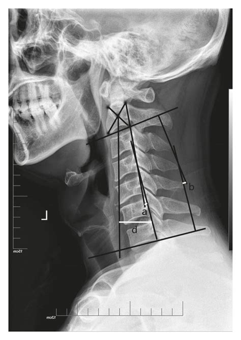 Cervical Sagittal Parameters 1 Cervical Curvature Jackson