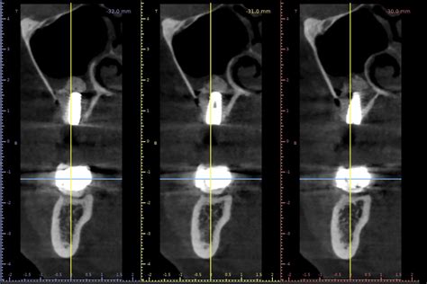 Lateral Sinus Floor Augmentation With Cerabone With 4 Year Follow Up