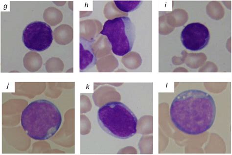 Dataset 2 Of Blood Smear Images For Different Types Of ALL 37