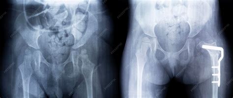 Osteotomia Antes E Depois - Raio x antes e depois da cirurgia osteotomia femoral filme de raio x da ...