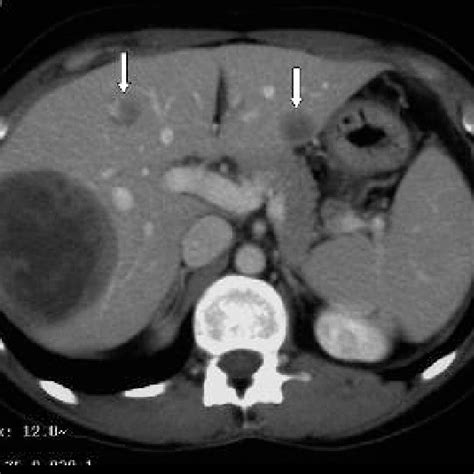 Ct Scan Of The Abdomen 7 8 Cm Hypodense Lesion In Liver Segment Vii