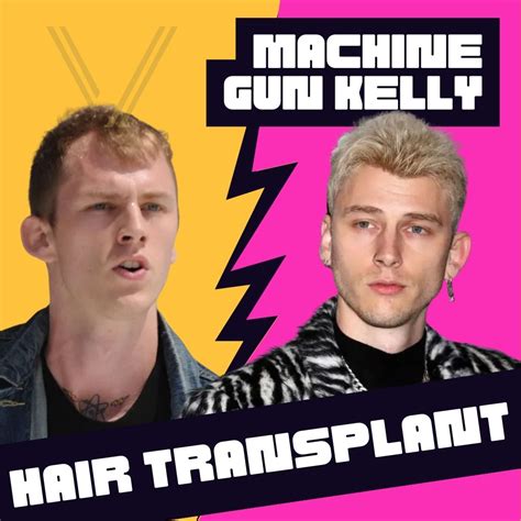 MGK S Hair Transplant Before And After Transformation