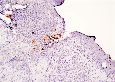 Pathology Outlines Herpes Simplex Virus