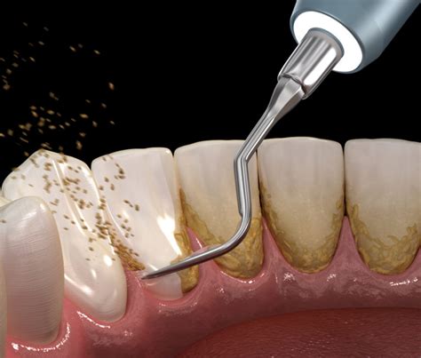 QUÉ ES EL SARRO Estudi Dental Barcelona