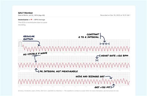 Sinus Rhythm Vs Ventricular Tachycardia Non Sustained On Your Watch Ecg Qaly