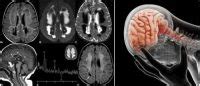 Leucoencefalopatía Qué es Signos Síntomas Causas Trastornos