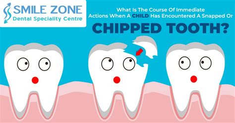 Some Care Tips For Your Broken Or Chipped Teeth And Its Treatment