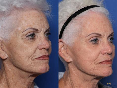 Sciton Laser Before And After Pictures Case 531 Fort Worth