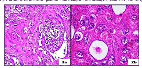 Figure From Squamoid Eccrine Ductal Carcinoma A Diagnostic