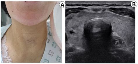 Is A Thyroid Biopsy Painful